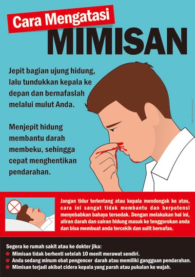 Cara Menangani Mimisan